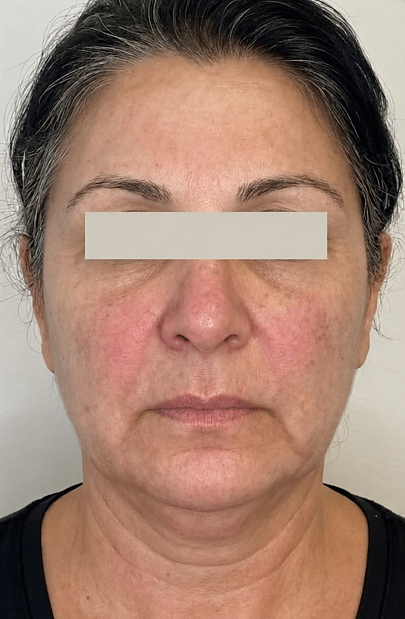 Before HIFU Turkey Neck Rescue treatment with Dr Wasia