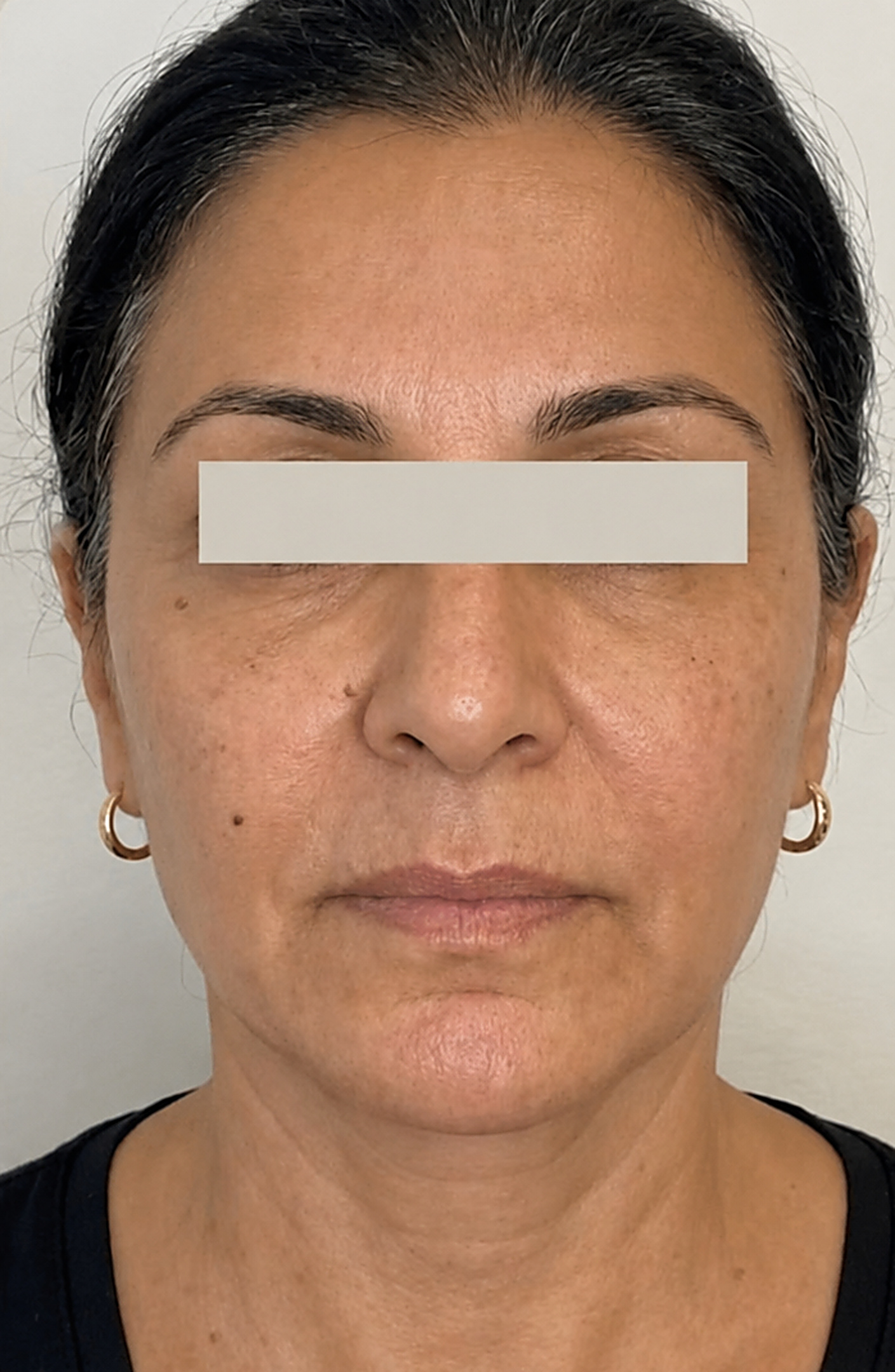 After HIFU Turkey Neck Rescue treatment with Dr Wasia